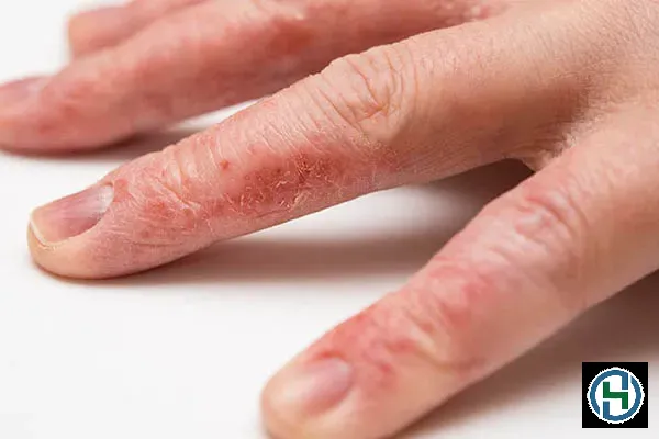 Tác hại của hóa chất tẩy rửa có thể khiến da tay lão hóa nhanh chóng nếu không được bảo vệ