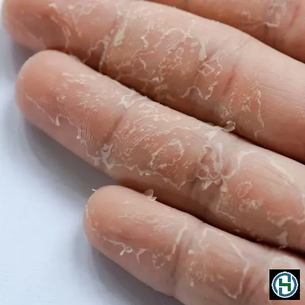 Tình trạng kích ứng da tay thường gặp khi sử dụng nước rửa chén chứa nhiều hóa chất
