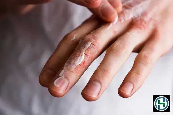 Các dấu hiệu nghiêm trọng của viêm da tiếp xúc do sử dụng nước rửa chén không đúng cách