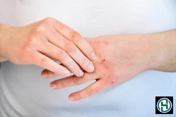 Việc tiếp xúc thường xuyên với hóa chất tẩy rửa mạnh có thể gây hại nghiêm trọng cho cấu trúc da tay