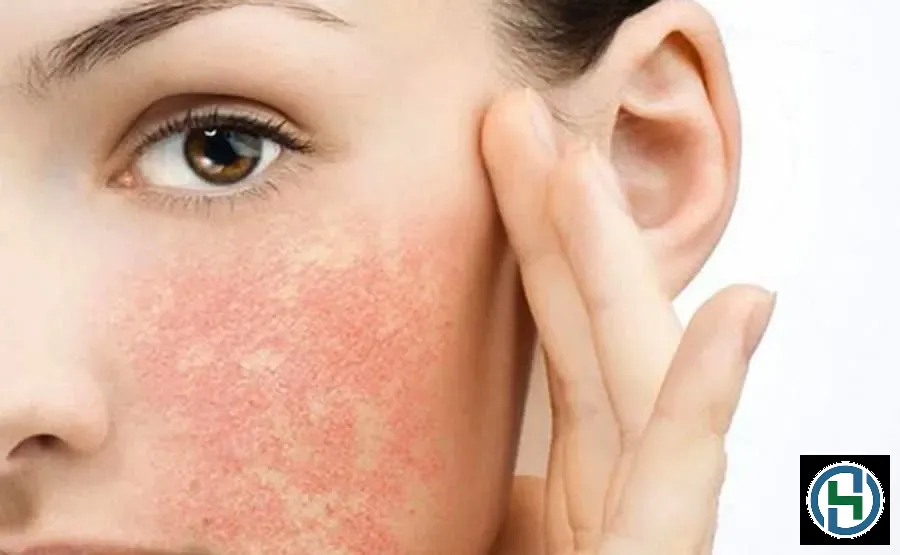 Tình trạng da bị kích ứng đỏ rát sau khi rửa mặt là vấn đề phổ biến cần được xử lý kịp thời