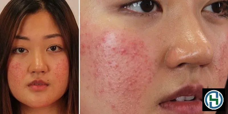 Các biểu hiện điển hình của da bị kích ứng bao gồm đỏ rát và bong tróc