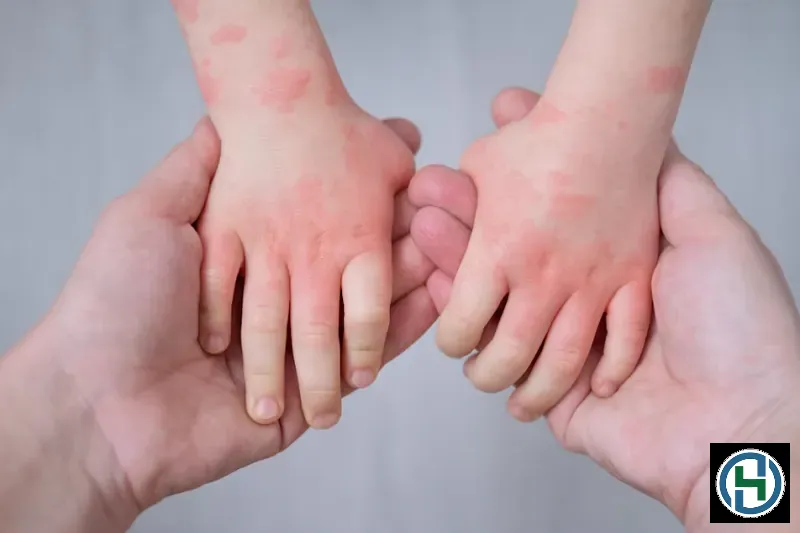 tre-bi-di-ung-noi-man-do-khap-nguoi-1 Các hóa chất tẩy rửa mạnh có thể gây kích ứng nghiêm trọng lên làn da nhạy cảm của trẻ