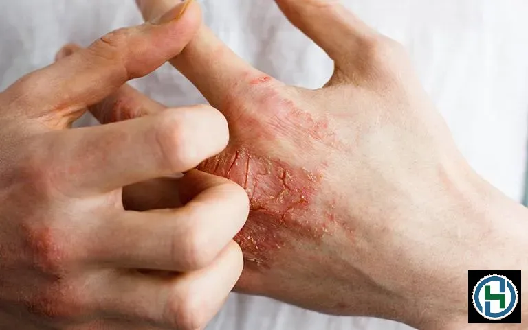Hóa chất tẩy rửa công nghiệp là nguyên nhân hàng đầu gây viêm da tiếp xúc